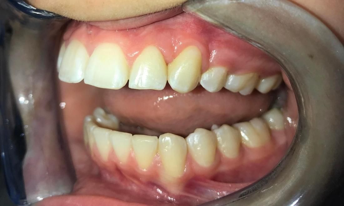 Braces and Invisalign - After - Right Side