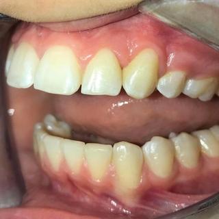 Braces and Invisalign - After - Right Side