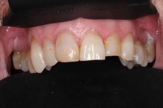 Dental Crowns 4 - Before