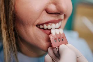 What are veneers?