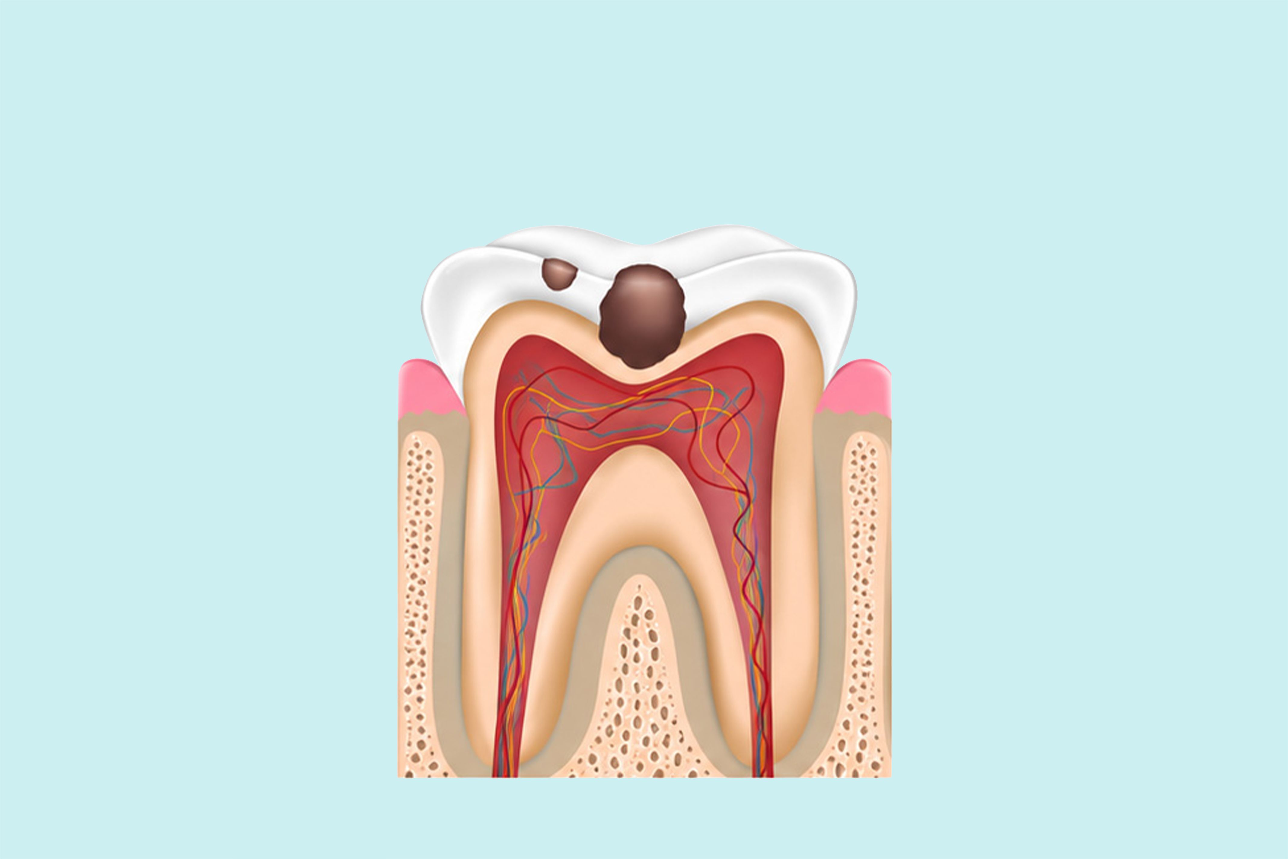 Step 2 — Removing the decay