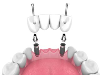 Implant Supported Bridges