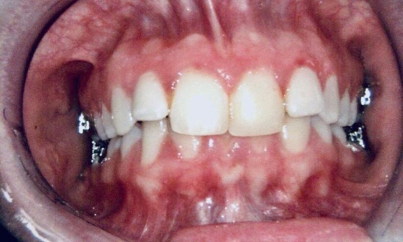 Braces and Invisalign - Before