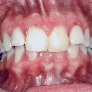 Braces and Invisalign - Before
