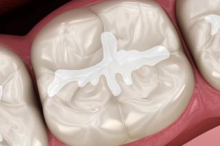 Fissure Sealants for Children