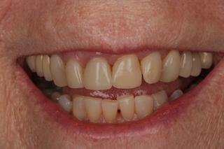Before image of a Crown and Bridge on a patient.