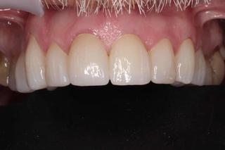 Dental Crowns 4 - After