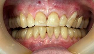 Ian after crown and bridge treatment.
