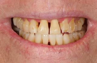 Before image of a Crown and Bridge on a patient.