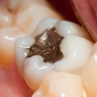 What Is a Dental Filling?