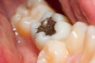 Tooth fillings