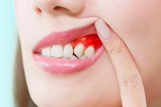 Pimples Forming Along the Gum Line