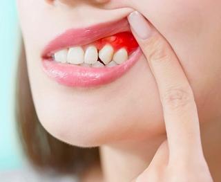 Severe Tooth Infection