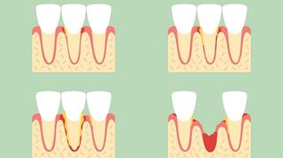 What Is Gum Disease?