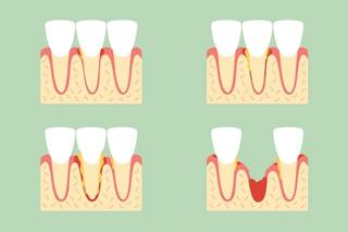 Wisdom tooth extraction