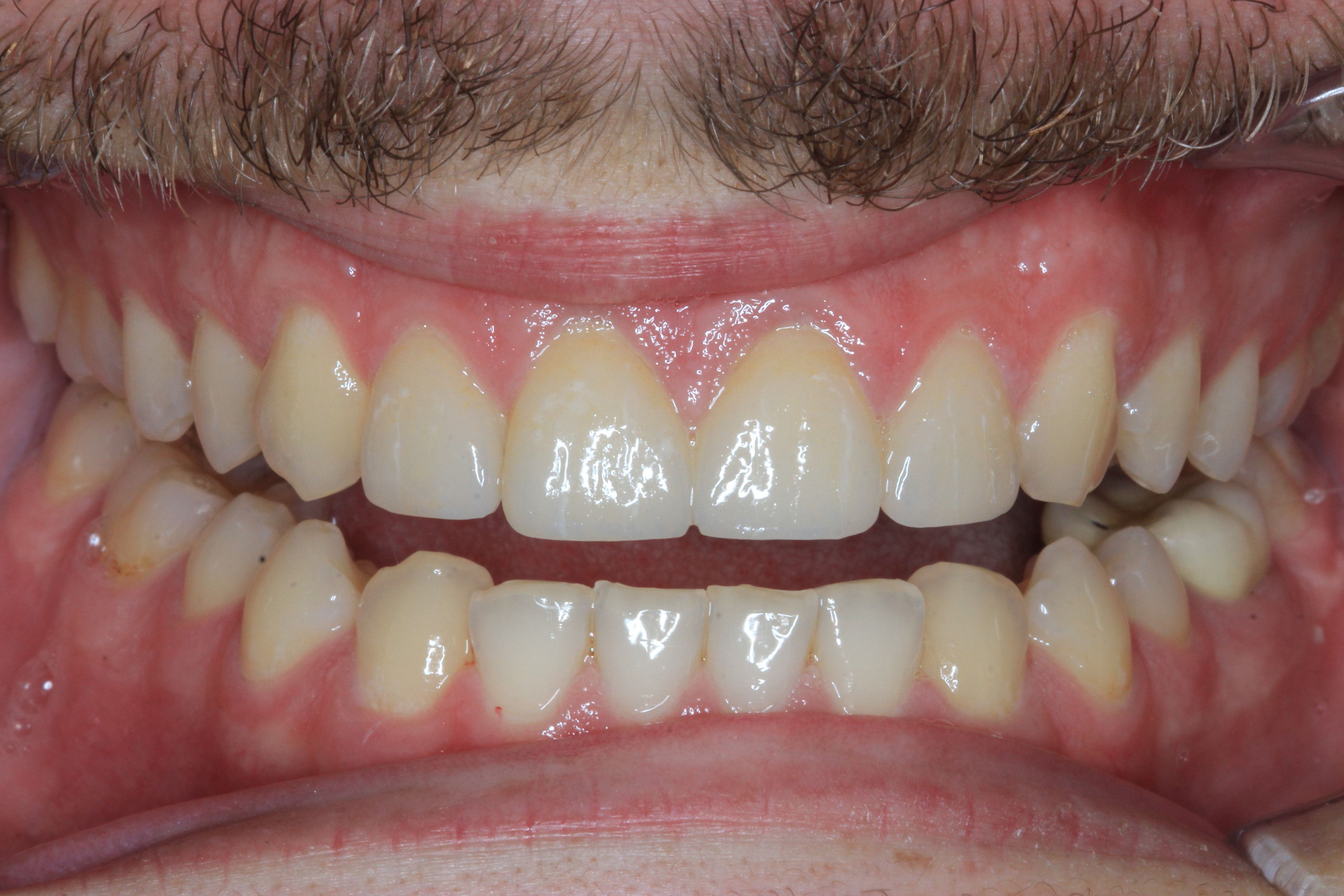 Crown Lengthening Surgery and Veneers