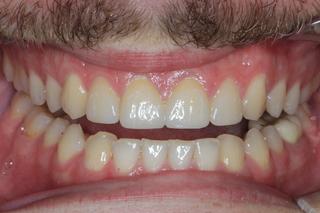 Crown Lengthening Surgery and Veneers