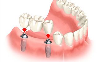 Dental Implant Diagram