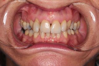 Dental Crowns 2 - Before