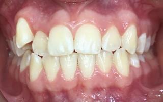 Invisalign transformation 001 (before)