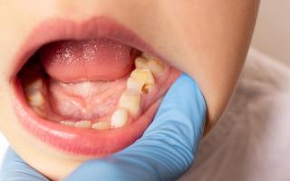 Image of a child with a chipped tooth.