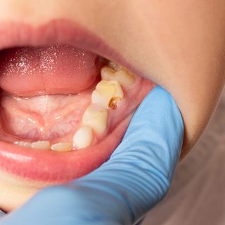 Missing or chipped teeth