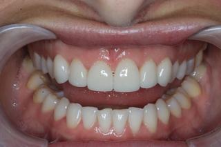 after smile design