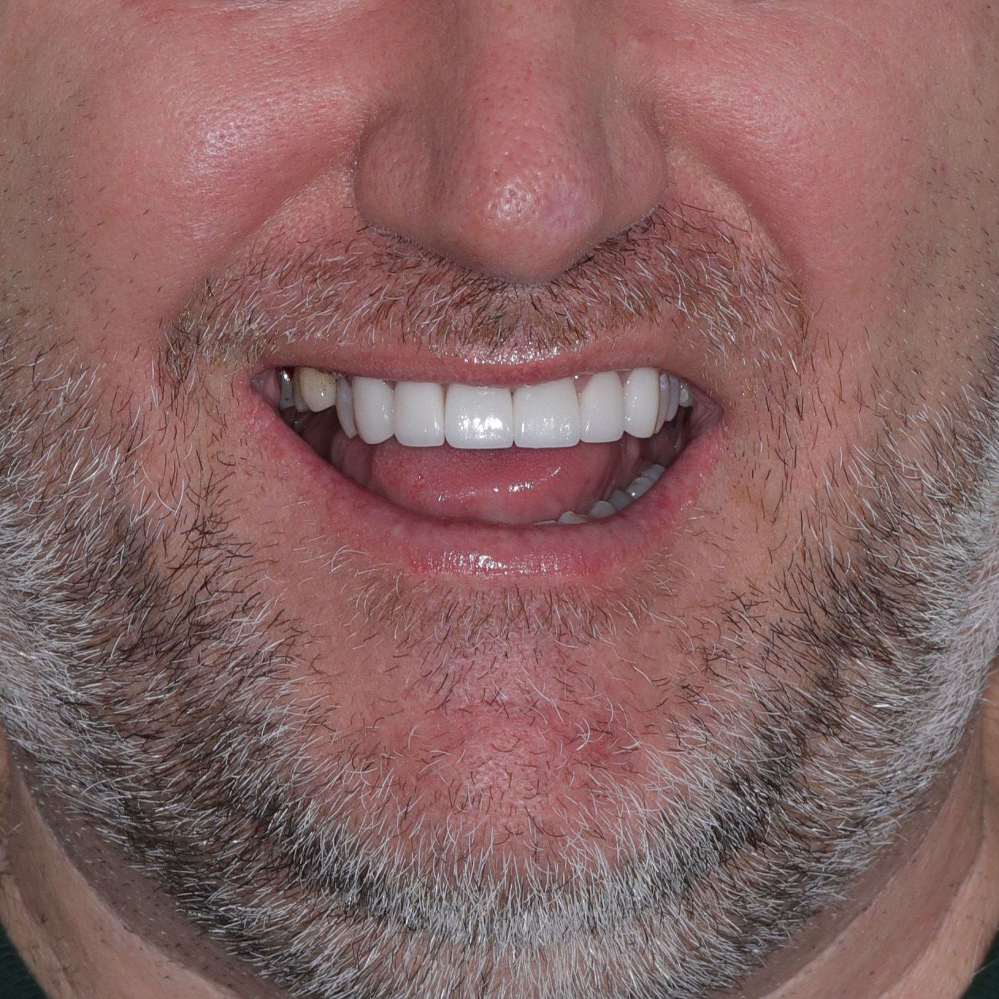 Porcelain Veneers & Crowns