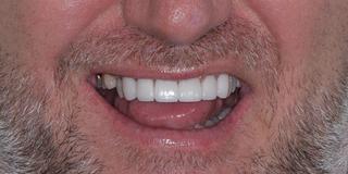 Porcelain Veneers & Crowns