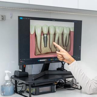 Dental Implants in Carnegie