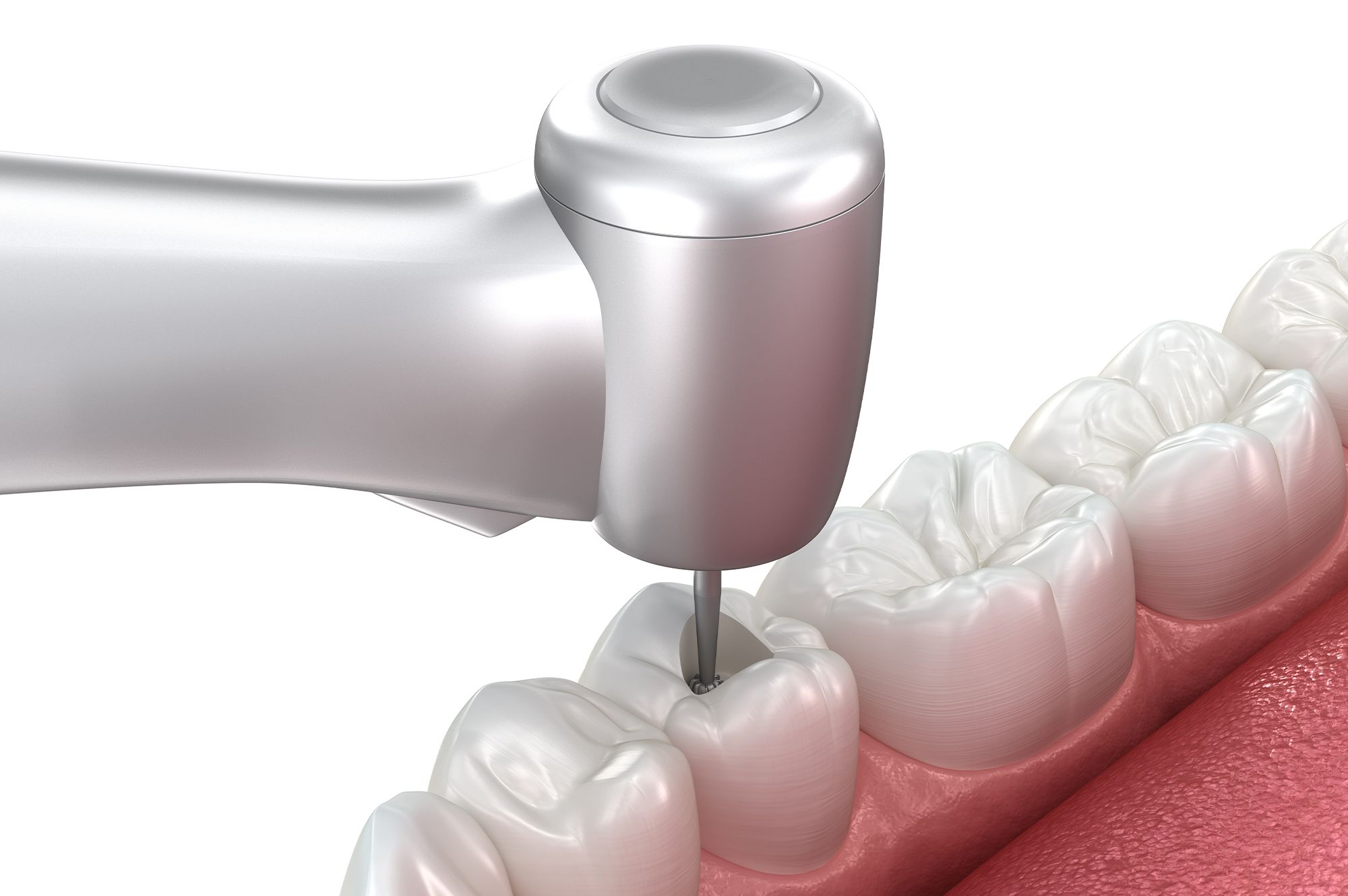 How Do I Know If I Need a Root Canal or a Filling? - Hero
