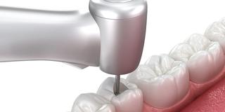 How Do I Know If I Need a Root Canal or a Filling? - Hero