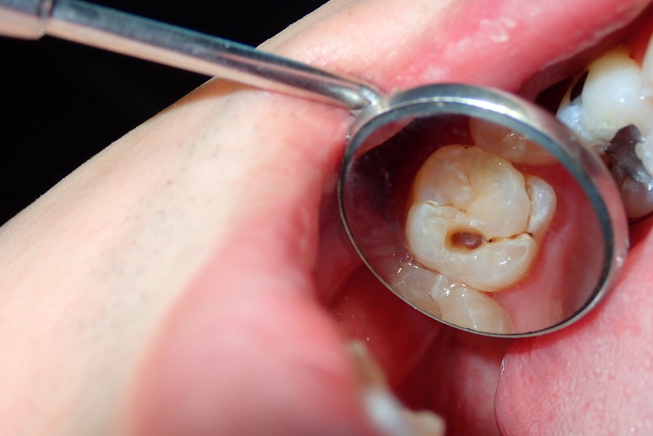 How to avoid tooth decay