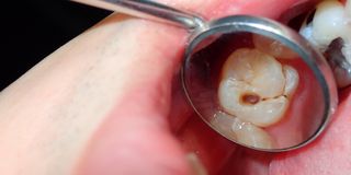 What's the deal with cavities?