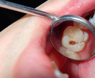 Dental decay or dental caries