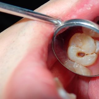 How to avoid tooth decay