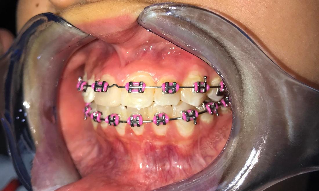 Braces and Invisalign - After - Right Side