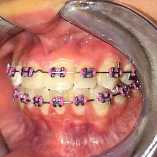 Braces and Invisalign - After - Right Side