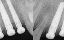 And finally, after implant placements using guides produced by siCAT in Germnany, final x-rays confirm ideal implant placements.