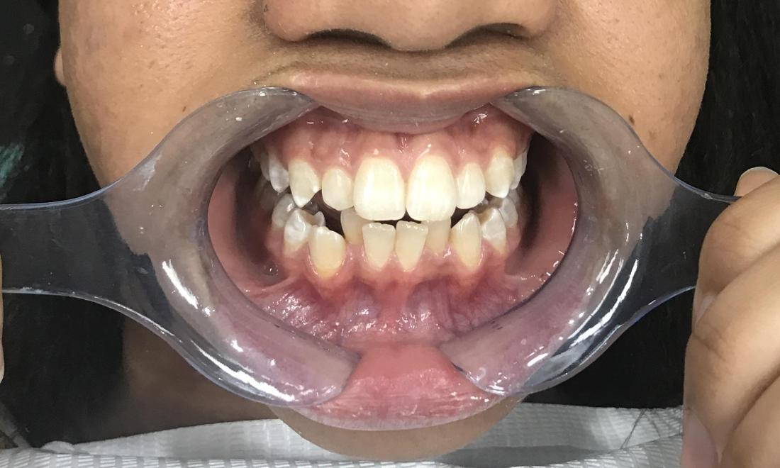 Braces and Invisalign - Before