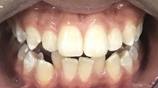Braces and Invisalign - Before