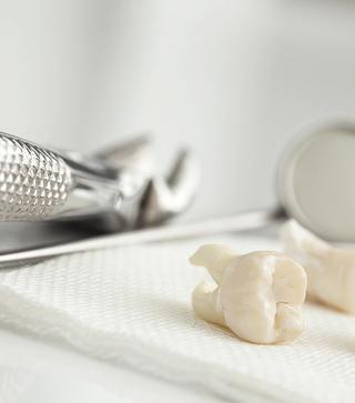 Tooth Extractions