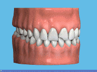 Using composite resin material (white material) to bond teeth and restore to full function