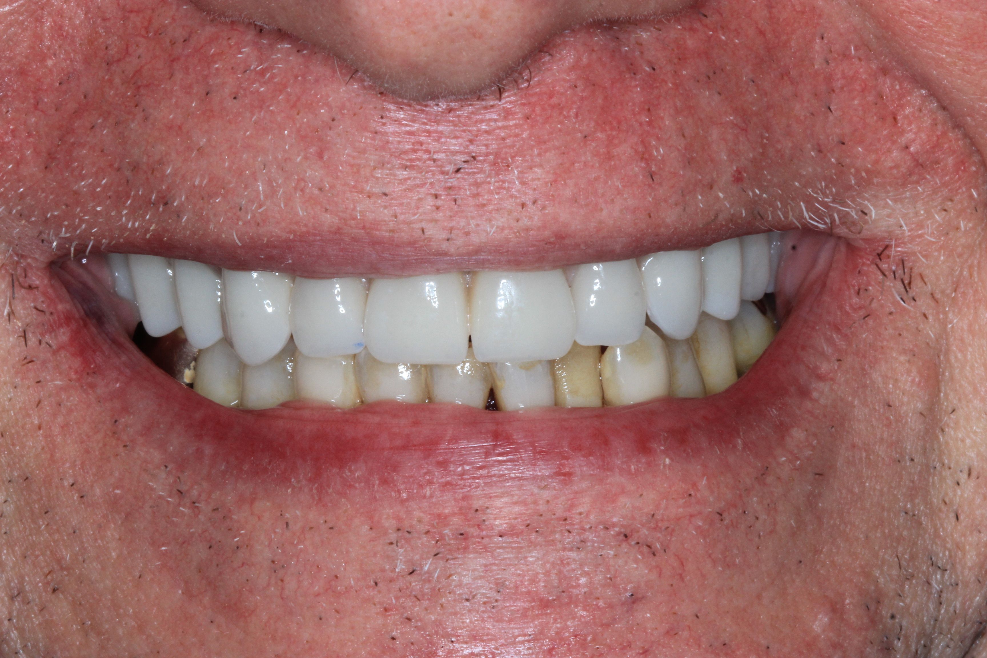 after implant retained denture