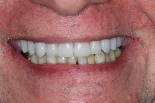 after implant retained denture