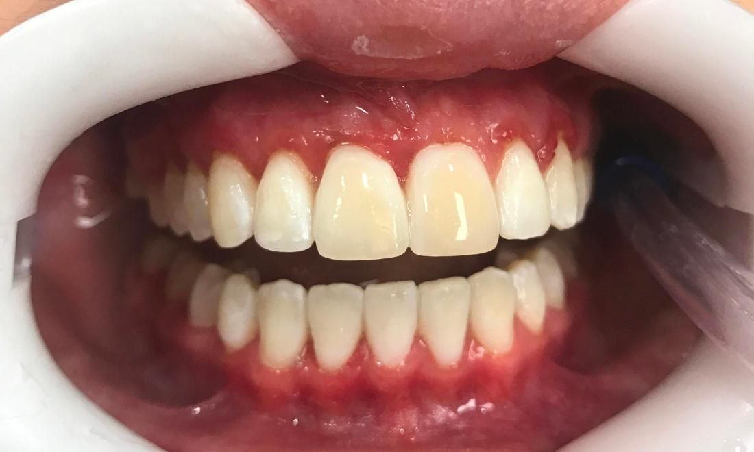Braces and Invisalign - After