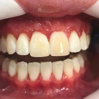 Braces and Invisalign - After