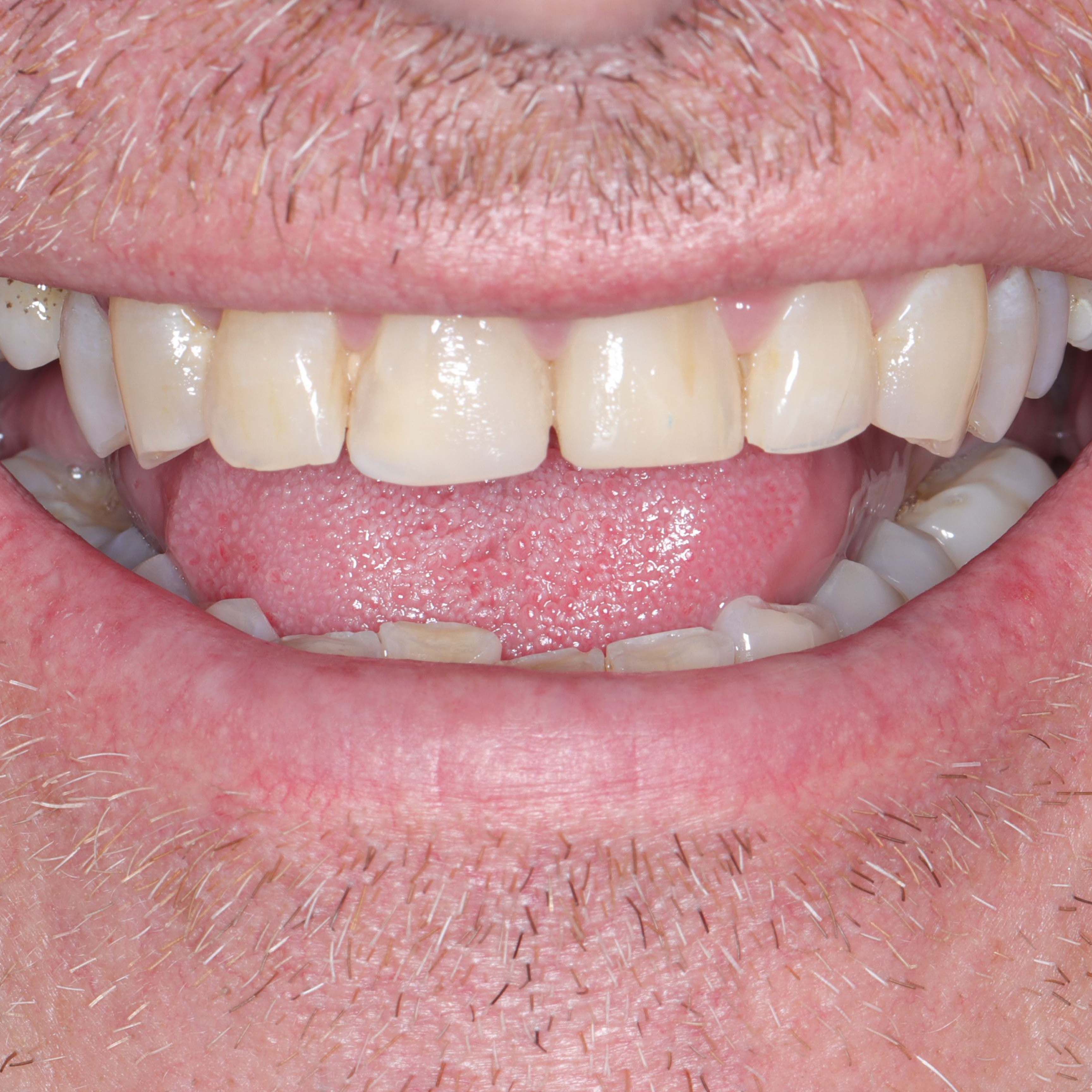 Porcelain Veneers & Crowns Before