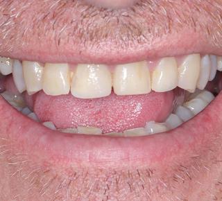 Porcelain Veneers & Crowns Before