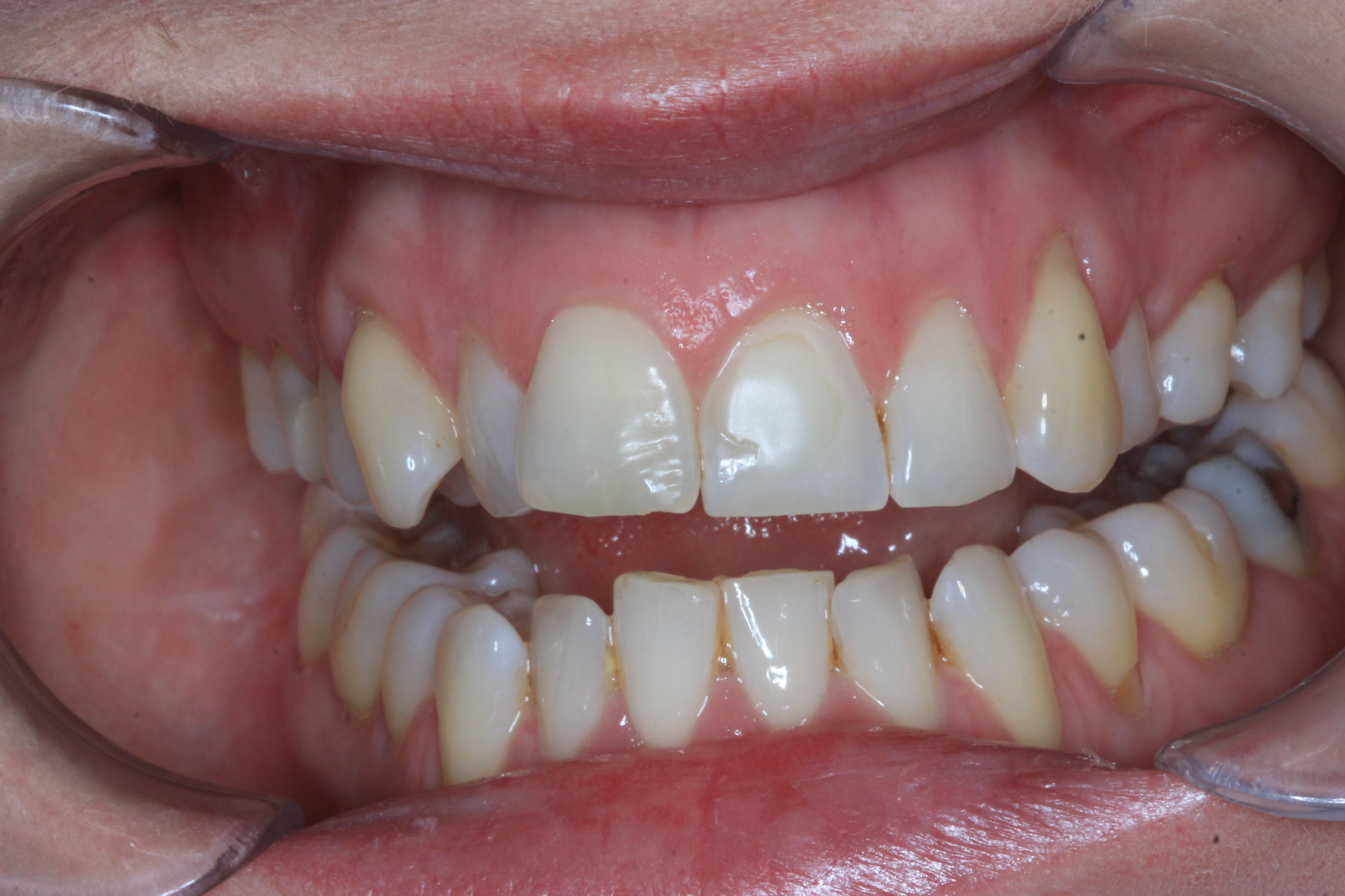 Veneers before